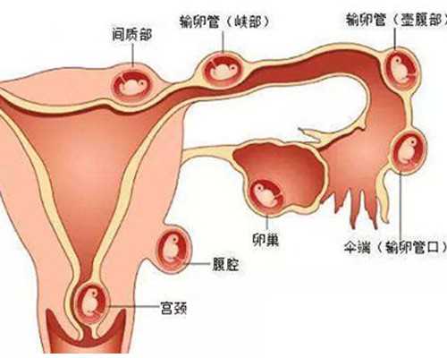 腰痛为何爱“裹”新成都助孕妈妈？